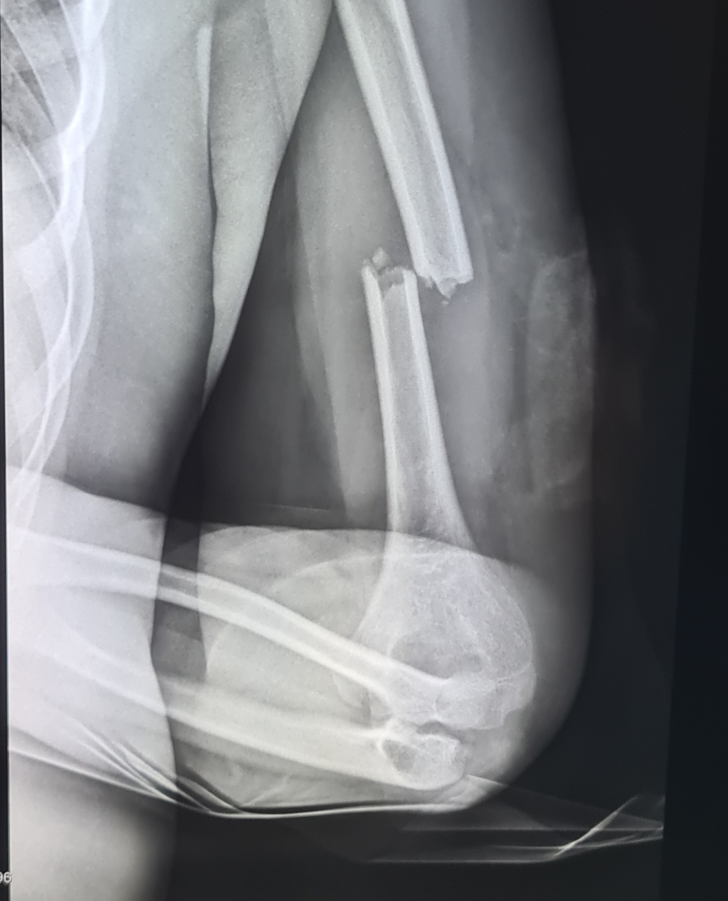 Egy nap alatt három gyerek is súlyos balesetet szenvedett elektromos rollerrel Egy nap alatt három gyerek is súlyos balesetet szenvedett elektromos rollerrel